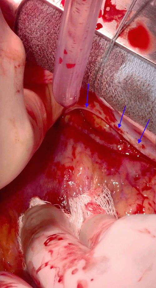 Edge of the pericardial defect (arrows); the left ventricle is visibly protruding through the defect.