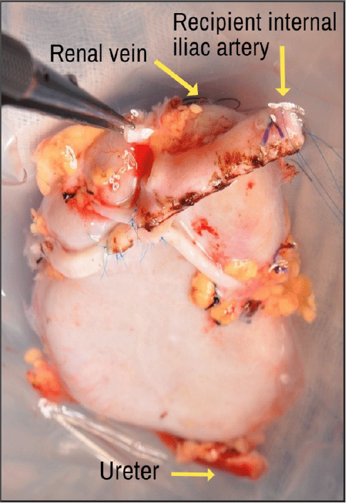 A) Back table reconstruction of donor renal arteries using the recipient's internal iliac artery and its branches