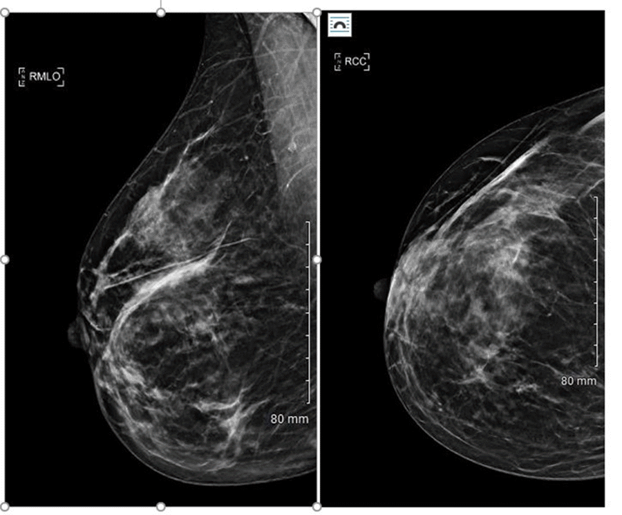 Right breast mammogram showing moderately extensive postoperative distortion in outer aspect of right breast. No asymmetric skin thickening. No dominant mass or suspicious calcifications. BIRADS 2-benign.