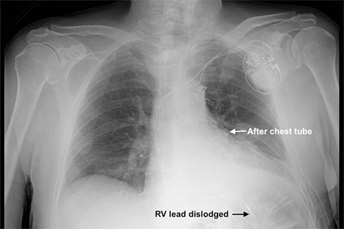 Externalized Rv Pacemaker Delayed Pneumothorax and Lead Dislodgement after Pacemaker Insertion in ...