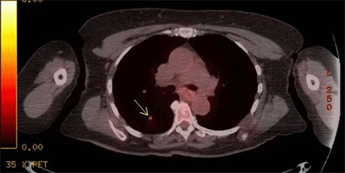 Well-circumscribed, round 9 mm right lower lobe mass (arrow) with mild increased FDG uptake; SUV max 1.5, concerning for metastatic deposit