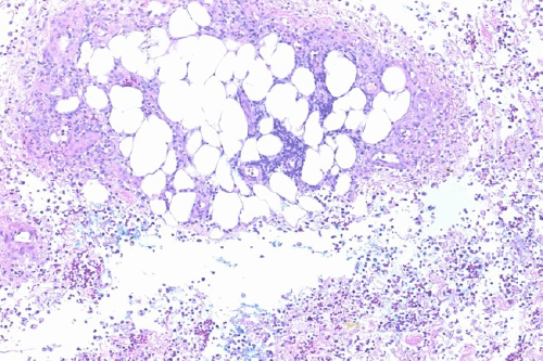Images demonstrate diffuse dermal and subcutaneous necrotizing neutrophilic inflammation.