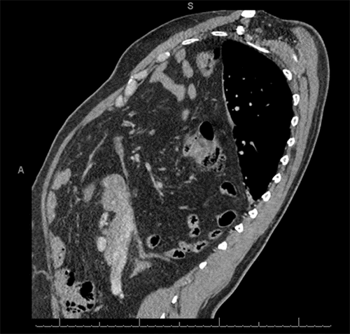 Axial views from a preoperative CT scan of the chest and abdomen. Note a large right-sided diaphragmatic hernia with substantial herniation of abdominal contents, including segments of the liver, mesenteric fat, and loops of small and large bowel, into the right hemithorax