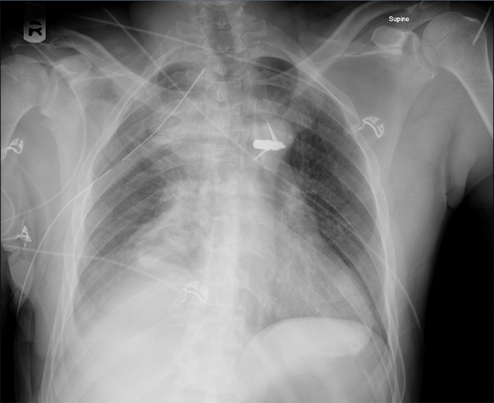 Figure 1. AP supine chest x-ray of a 51-year-old man upon arrival to the trauma bay with a penetrating arrow thoracic injury