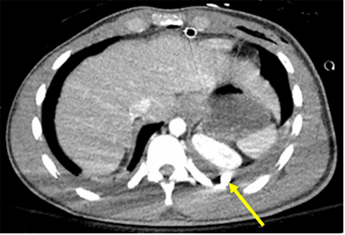 Figure 4. Axial CT image of patient with Transmediastinal gunshot wound depicting bullet location. Solid yellow line indicates the position of the bullet in the left diaphragmatic sulcus, posterior to the left kidney on CT scan.