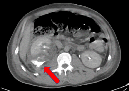 B) Delayed CT imaging, demonstrating extravasation of urine from the mid-pole calyx of the right kidney.
