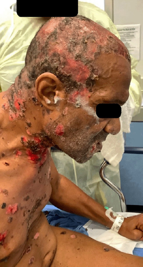 Clinical photograph (right lateral view) highlighting severe pemphigus vulgaris lesions across the scalp. Areas of active blistering, erosions, and re-epithelialization with associated scarring are evident