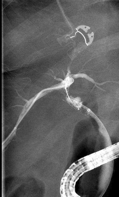 Figure 5. Cholangiogram image taken during combined IR/GI rendezvous procedure. An ERCP wire (thin arrow) was fed up through the cystic duct into the right posterior section, where PTBD was already in place. An IR snare (thick arrow) was used to capture the ERCP wire. 