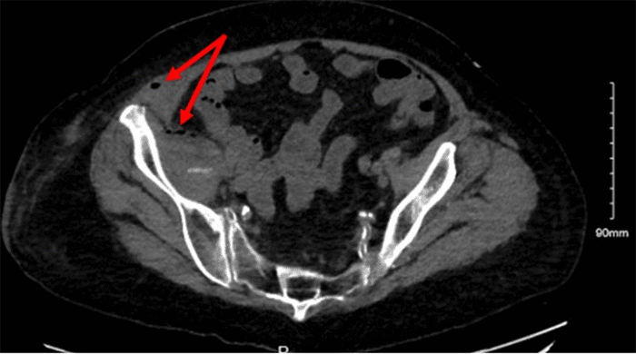 CT Abdomen and Pelvis showing small bubbles of gas and heterogeneity of the iliacus muscle as well as gas in the right abdominal wall.