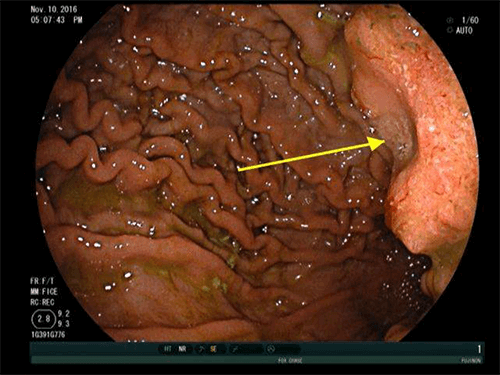 Figure 1. EGD revealed a 3 cm, raised, fungating, mass with central depression (“bull’s eye sign”, yellow arrow) in the gastric body along the lesser curvature just above the incisura.