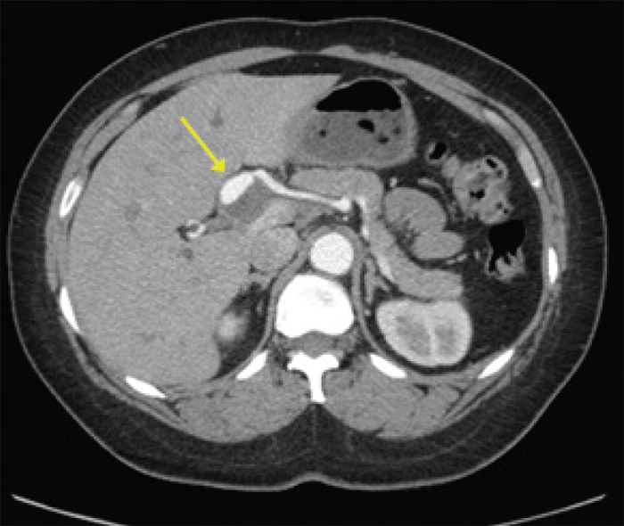 Hepatic Artery Aneurysms: An Uncommon Presentation of a Deadly Disease ...