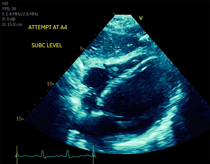 Apical four-chamber view from a transthoracic echocardiogram performed on postoperative day 0