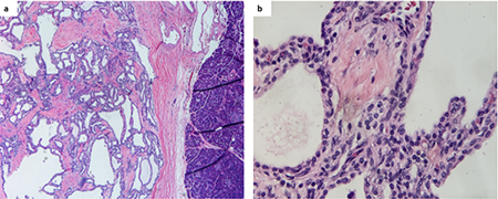 Figure 3. (a) Low-power H&E showing microcystic serous cystadenoma adjacent to the normal pancreatic parenchyma. The microcystic and macrocystic spaces are lined by small cuboidal epithelial cells. (b) High-power H&E demonstrates small and bland nuclei without atypia, hyperchromasia, pleomorphism, and mitotic activity.