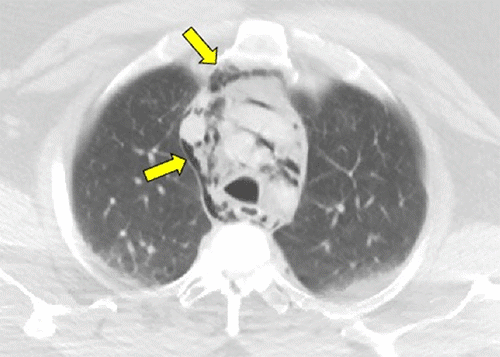 A) Chest CT depicting air in pneumomediastinum—yellow arrows show air