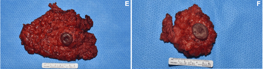 E) Right mastectomy with lateral margin to left of page with notable nipple retraction. F) Left mastectomy with lateral margin to right of page with notable nipple retraction—additional excised margins not shown.