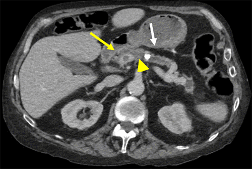 Scans demonstrate a pancreatolith (white arrow) with upstream pancreatic duct dilation and focal pancreatic necrosis (yellow arrow). There is a small thrombus located in the adjacent SMV (arrowhead)