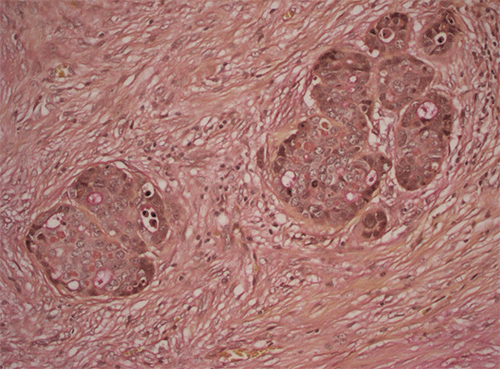 (C) Mucicarmine stain (200x magnification) highlighting mucin production by the tumor, confirming the presence of an adenocarcinoma component