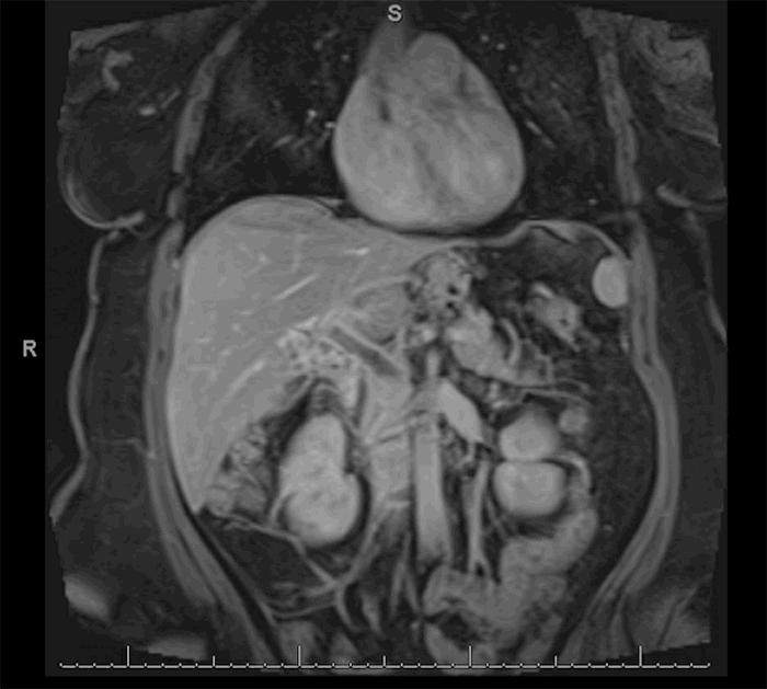 Extensive Portomesenteric Venous Thrombosis after Laparoscopic Sleeve