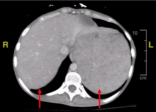 (A) Axial view demonstrating hepatosplenomegaly. The spleen measures approximately 23 × 15 × 9 cm at its largest dimensions