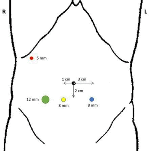 8 mm robotic working port 3 cm to left and 2 cm below umbilical region (blue); 8 mm robotic camera port 1 cm to right and 2 cm below umbilical region (yellow); 12 mm robotic working port in right lower quadrant (green). A 5 mm laparoscopic assistant port in right upper quadrant (red). 