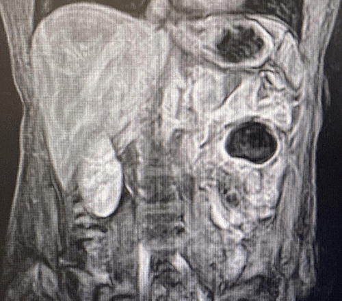 Scan demonstrating approximate 5 × 4 × 4 cm jejunal mesenteric mass most consistent with mature cystic teratoma, with induration of surrounding mesentery.