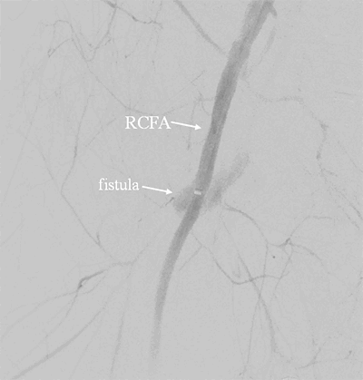 Figure 5. Right AVF after stent deployment. Light blush visualized, demonstrating persistent fistula, although flow through fistula greatly decreased. RCFA=right common femoral artery.