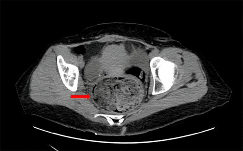 The rectum measures approximately 10.1 cm in diameter