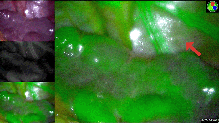 Intraoperative image of the ICG fluorescent spleen, indicating adequate perfusion after division of the short gastric arteries