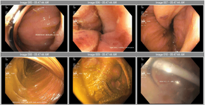 Grossly distended colon with colonic looping is demonstrated; however, a clear transition point diagnostic of volvulus is absent