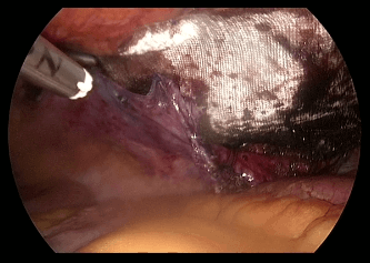 Figure 5. Mesh in preperitoneal space, beginning coverage by flap of peritoneum