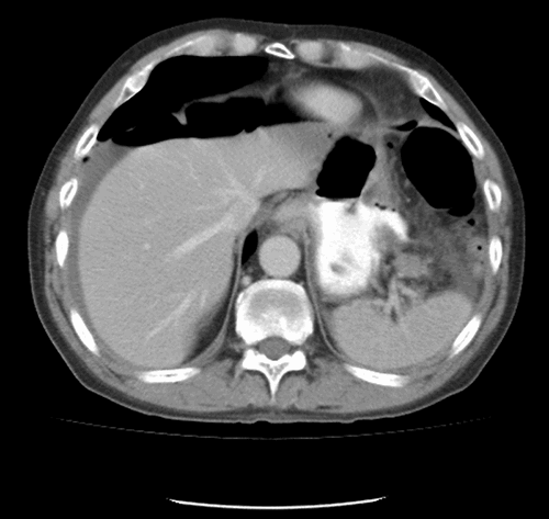 Figure 1. CT scan of abdomen done in ED on admission.