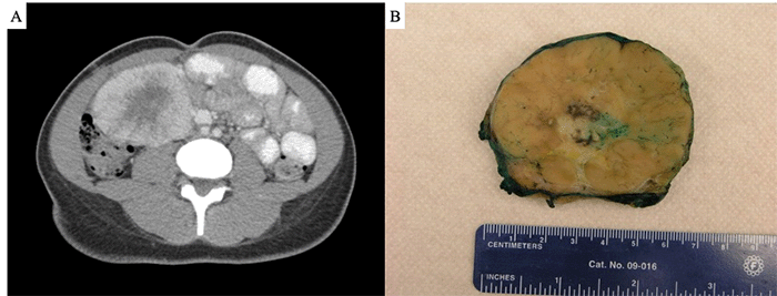 (A) CT scan demonstrating a large mass at the confluence of the small bowel and right colon mesentery. (B) Gross pathology of a well-circumscribed 8.8 × 7.8 × 5.9 cm mass.