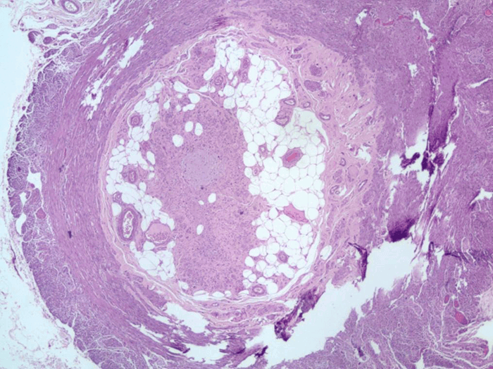 Figure 4. Hematoxylin and eosin stain showing a normal appendix