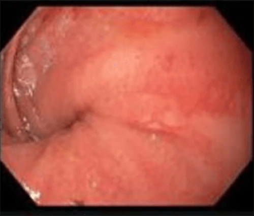 Figure 1. Endoscopic view showing pinwheeling of pouch torsion (2017)