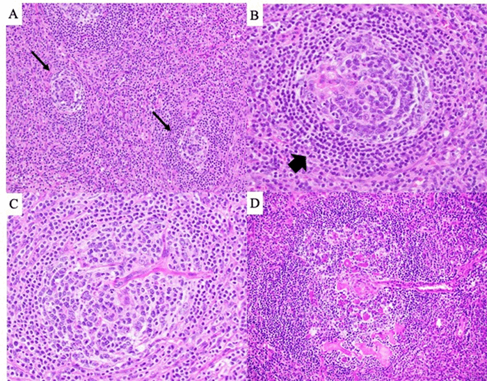 (A) Atretic follicles (arrows), 100x magnification. (B) "Onion skinning" of the mantle zone (arrow), 200x magnification. (C and D) Vessels penetrating follicles at right angles, 200x magnification.