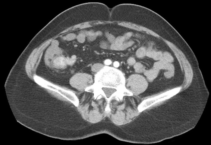 Figure 3. Preoperative CT abdomen demonstrating enhancing terminal ileum carcinoid tumor with surrounding ileocolic adenopathy