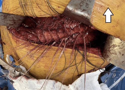 B) closure of intercostal hernia with Tiger Tape (arrow points cranial)