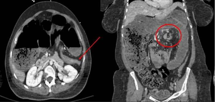(A) Axial and (B) Coronal views from a contrast-enhanced CT scan of the abdomen and pelvis. Note  massive distension of the transverse and descending colon, with a characteristic "whirl sign" or abrupt transition point at the splenic flexure, confirming splenic flexure volvulus