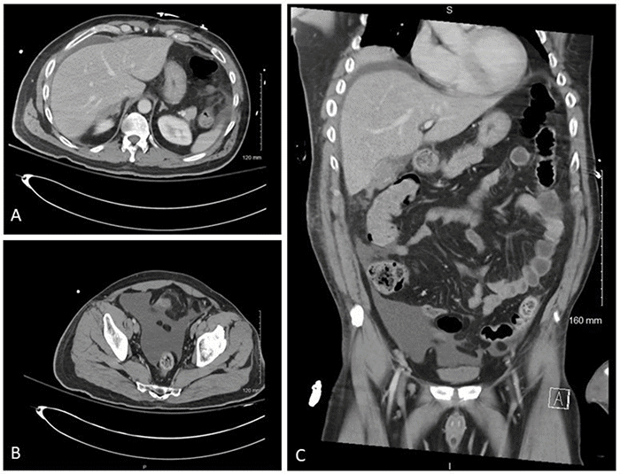 CT of the abdomen and pelvis on hospital day 3 demonstrating intra-abdominal fluid accumulation. (A) Axial view showing free fluid in the right perihepatic space. (B) Axial view showing ascites in the lower pelvis. (C) Coronal view showing free fluid in the right perihepatic space, right paracolic gutter, and lower pelvis