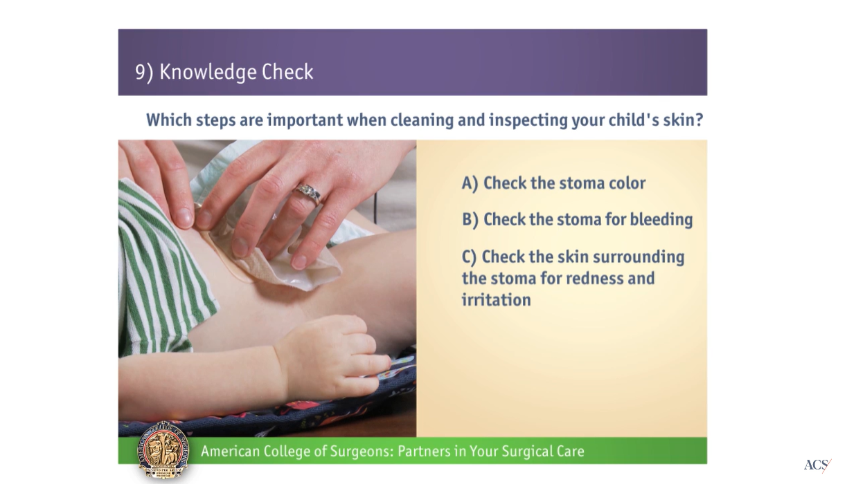 Pediatric Urostomy: Knowledge Check