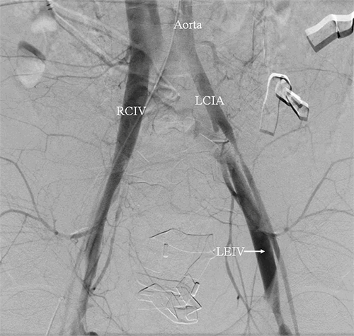 Figure 1. Aortic run of angiogram with injection of contrast into femoral arteries with immediate opacification of the venous system bilaterally, suggesting presence of an arteriovenous fistula. LCIA=left common iliac artery; RCIV=right common iliac vein; LEIV=left external iliac vein.