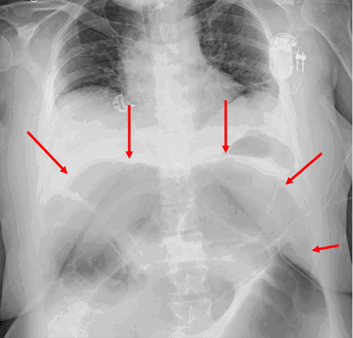 Splenic Fixurfe Splenic Flexure Syndrome After Colonoscopy