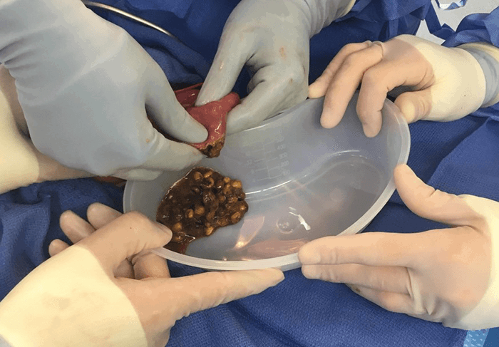 Figure 4. Intraoperative image revealing the gross appearance of the extracted popcorn kernels, which measured 5cm by 4cm by 4cm in aggregate. The enterotomy through which the kernels were extracted is also shown. 