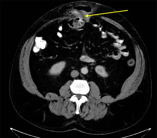 Axial CT scan from October 24, 2019, demonstrating the patient’s chronic ventral abdominal wall hernia. The image shows bowel loops and their associated mesentery (arrow) incarcerated within the hernia sac, without radiographic evidence of strangulation or perforation at that time