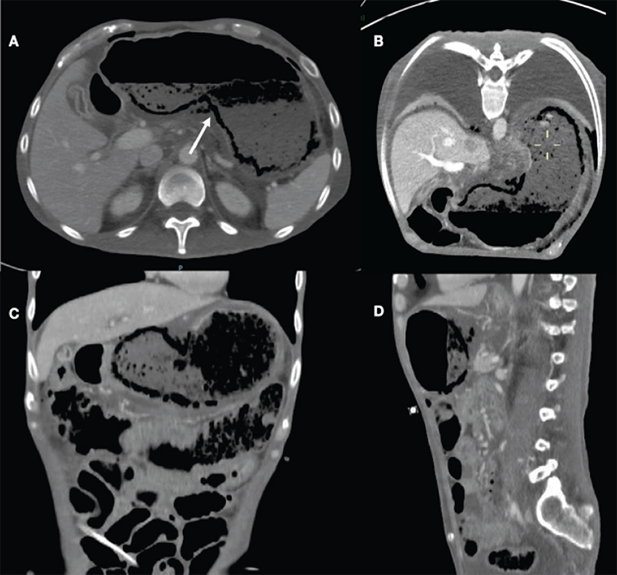 Gastric wall thickening associated with gastric pneumatosis and absence of mucosal enhancement predominantly in lesser curvature.