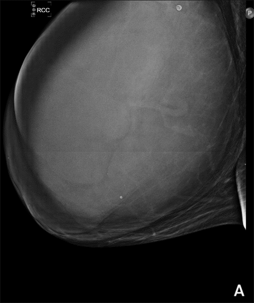 A) Right Craniocaudal View of Breast on Mammogram