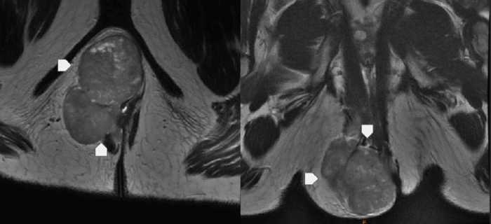 T2-weighted MRI of the pelvis. (A) Axial and (B) Coronal views demonstrating a large, well-circumscribed, encapsulated mass within the right ischiorectal fossa. The mass exerts significant mass effect, displacing the anorectal structures medially, but shows no definitive evidence of local invasion into adjacent muscle or bone