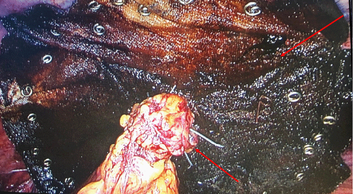 Upper arrow: mesh covering the defect. Lower arrow: omental flap interposed between the colostomy and mesh keyhole