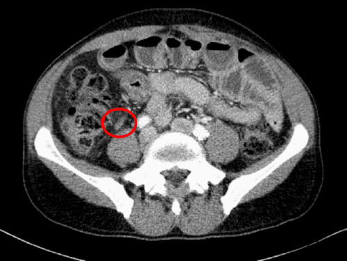 Axial view from a prior CT scan from 2017. This image retrospectively confirms the retrocecal position of the patient’s normal-appearing appendix (arrow), demonstrating its close proximity to the right psoas muscle, which explains its predisposition to form a contained retroperitoneal perforation