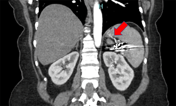 CTA revealing collateral blood flow to the spleen, with artifact due to prior embolization material